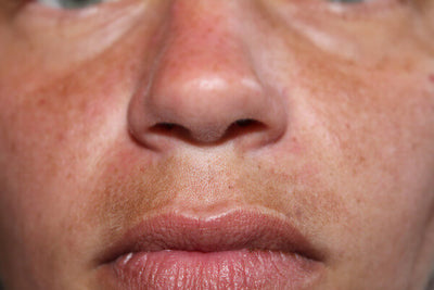 How Many Laser Hair Removal Sessions Do You Need for Upper Lip?