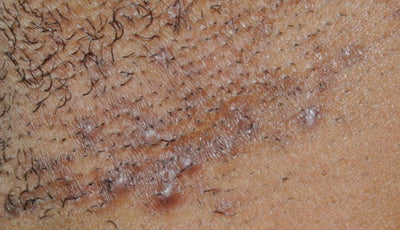 Can Laser Hair Removal Eliminate Ingrown Hair Scars?