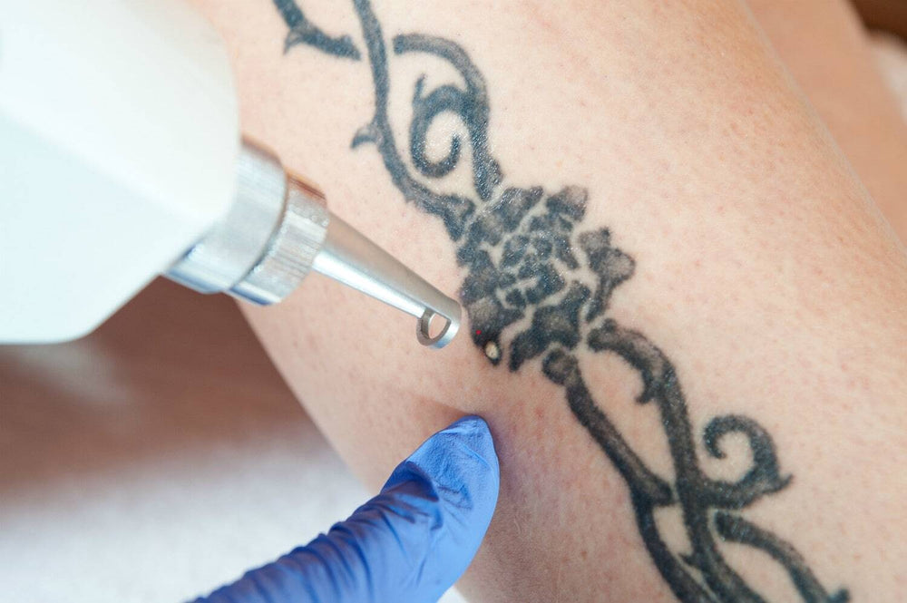 Permanent Tattoo Removal  The Unbearable Pain Of Parting From It