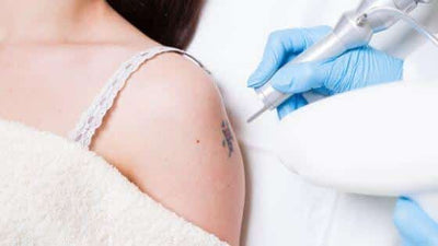 6 Key Factors That Affect Laser Tattoo Removal