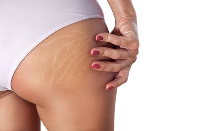 How to reduce the appearance of stretch marks